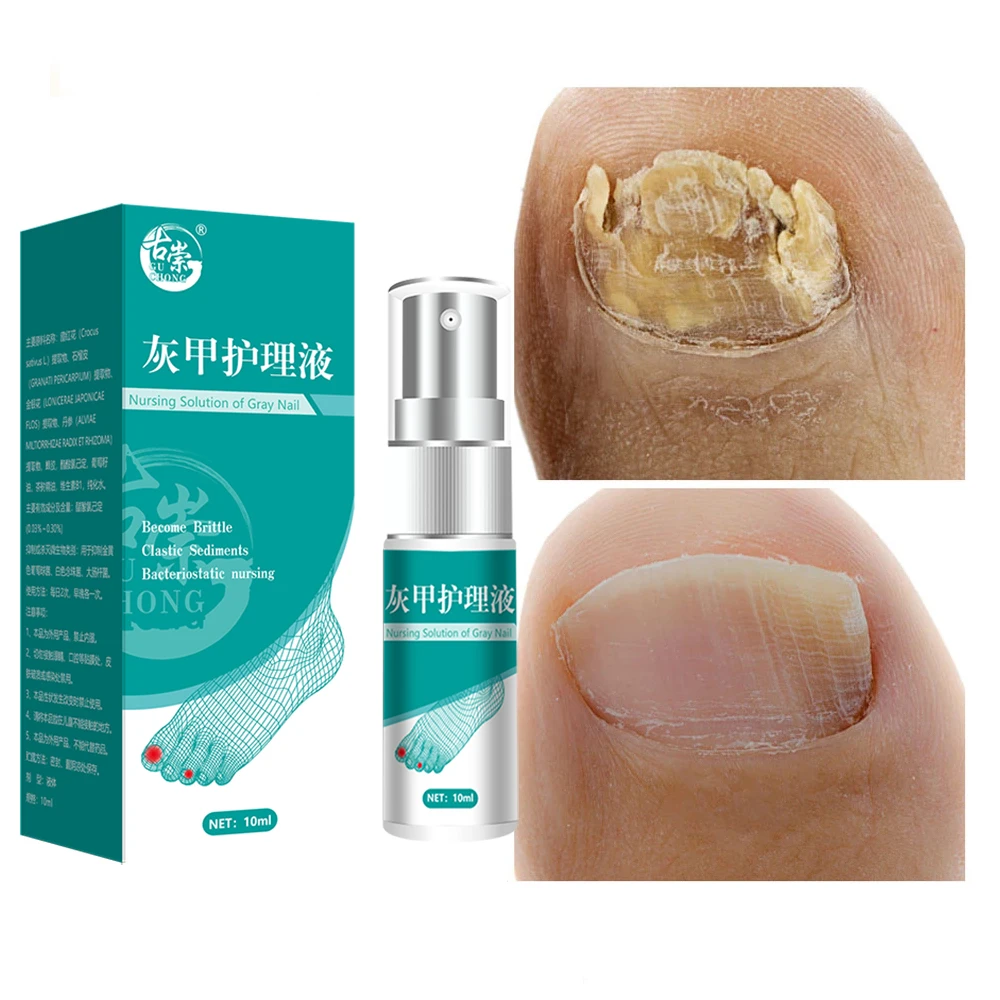 Nail Fungal Treatment Feet Care Essence Nail Foot Whitening Toe Nail Fungus Removal Gel Anti Infection Paronychia Onychomycosis
Nail Fungal Treatment Feet Care Essence Nail Foot Whitening Toe Nail Fungus Removal Gel Anti Infection Paronychia Onychomycosis