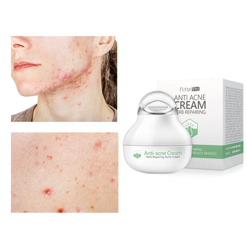 Effective Anti-acne Cream Acne Treatment Fade Acne Spots Oil Control Shrink Pores Whitening Moisturizing Acne Cream Skin Care
Effective Anti-acne Cream Acne Treatment Fade Acne Spots Oil Control Shrink Pores Whitening Moisturizing Acne Cream Skin Care