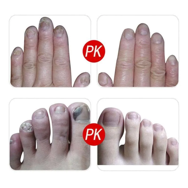 1pair Ingrown Nail Correction Nail Fixer Embed Toenail Tool Recover Lifter Foot Pedicure Correction Tool Care Pedicure U7Y5
1pair Ingrown Nail Correction Nail Fixer Embed Toenail Tool Recover Lifter Foot Pedicure Correction Tool Care Pedicure U7Y5