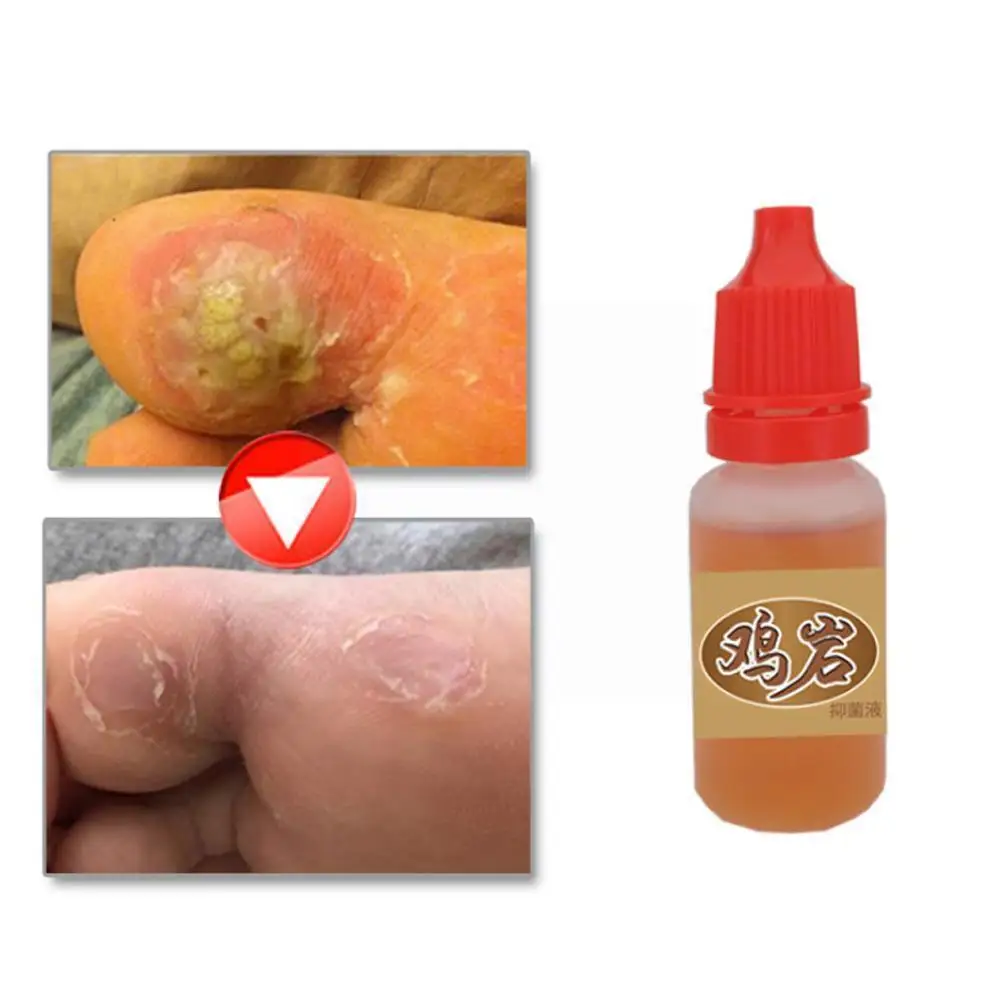 Effective Body Warts Treatment Cream Foot Corn Removal Cream Traditional Care Ointment Chinese Warts Foot Plantar Genital J0L0
Effective Body Warts Treatment Cream Foot Corn Removal Cream Traditional Care Ointment Chinese Warts Foot Plantar Genital J0L0