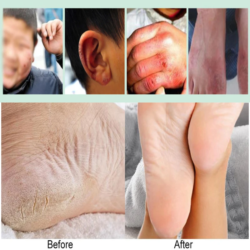 Crack Cream Repair Anti Crack Cream Dry Skin Chapped Peeling Removal Dead Skin Hand Feet Care Crack Cream
Crack Cream Repair Anti Crack Cream Dry Skin Chapped Peeling Removal Dead Skin Hand Feet Care Crack Cream