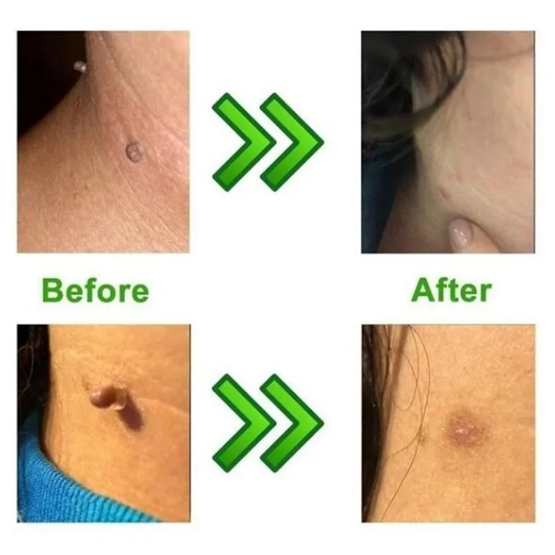 Skin Tag Removal Kit Durable Home Use Mole Wart Remover Micro Skin Tag Treatment Tool Easy To Clean Skin Care Tool
Skin Tag Removal Kit Durable Home Use Mole Wart Remover Micro Skin Tag Treatment Tool Easy To Clean Skin Care Tool
