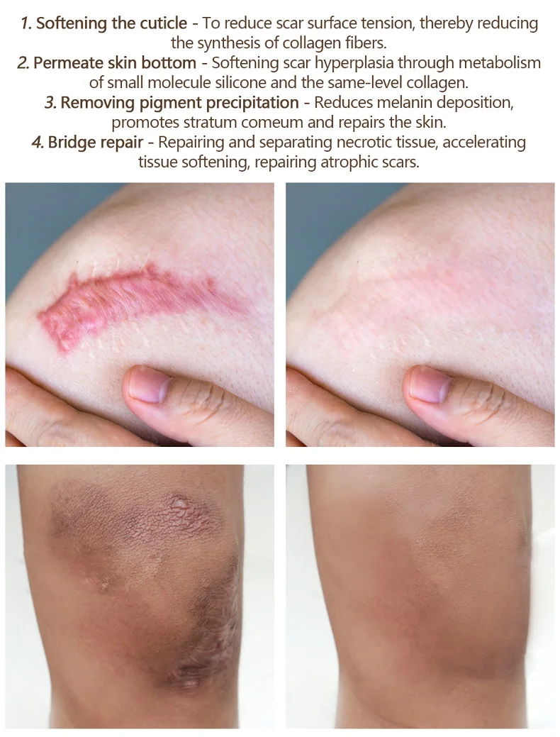 Wound scar repair gel acne scar cream acne stretch marks facial care body skin care moisturizing whitening 
Wound scar repair gel acne scar cream acne stretch marks facial care body skin care moisturizing whitening