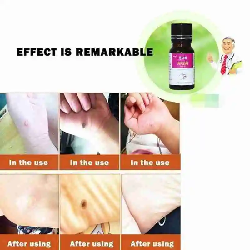 10ML Genital Wart Treatment Papillomas Removal of Warts Liquid From Skin Tags Removing Against Moles Remover Anti Verruca Remedy
10ML Genital Wart Treatment Papillomas Removal of Warts Liquid From Skin Tags Removing Against Moles Remover Anti Verruca Remedy