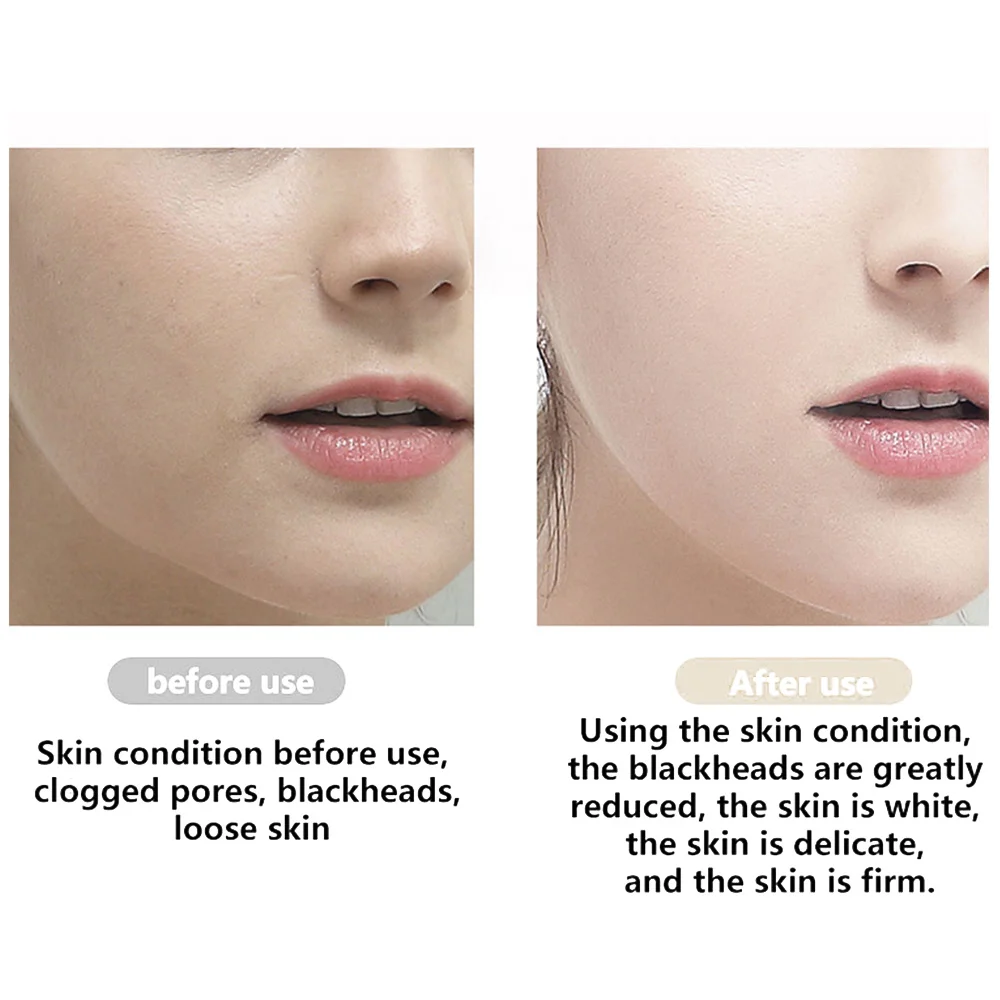 Shoveling Machine Ultrasonic Skin Scrubber Facial Exfoliating Pore Deep Cleansing to Blackheads + Electric Cleansing Device
Shoveling Machine Ultrasonic Skin Scrubber Facial Exfoliating Pore Deep Cleansing to Blackheads + Electric Cleansing Device