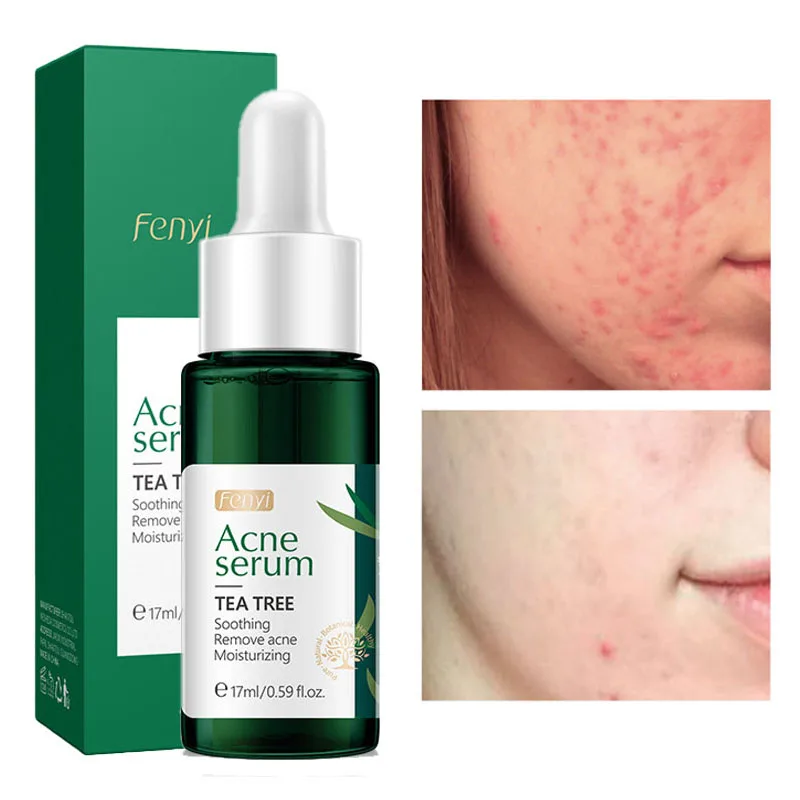 Anti-Acne Serum Improve Acne Fades Acne Marks Repair Shrink Pores Moisturizing Whitening Soothes Skin Nourish Face Skin Care
Anti-Acne Serum Improve Acne Fades Acne Marks Repair Shrink Pores Moisturizing Whitening Soothes Skin Nourish Face Skin Care