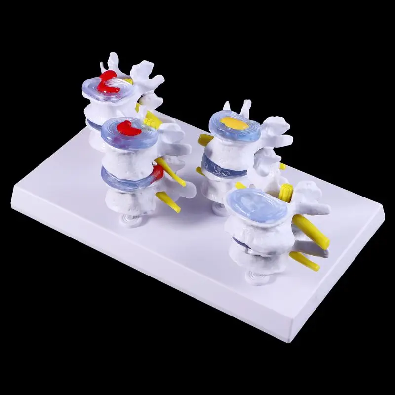 1 Set Human Lumbar Lesion Spine Statue Display Model Teaching Learning Tool
1 Set Human Lumbar Lesion Spine Statue Display Model Teaching Learning Tool