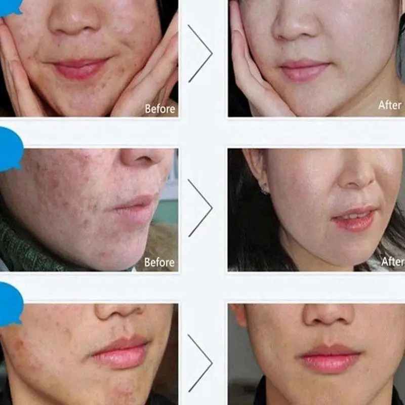 Removal Acne Treatment Blackhead Cream Shrink Pore Face Scar Care Oil Control Whitening 30ml
Removal Acne Treatment Blackhead Cream Shrink Pore Face Scar Care Oil Control Whitening 30ml