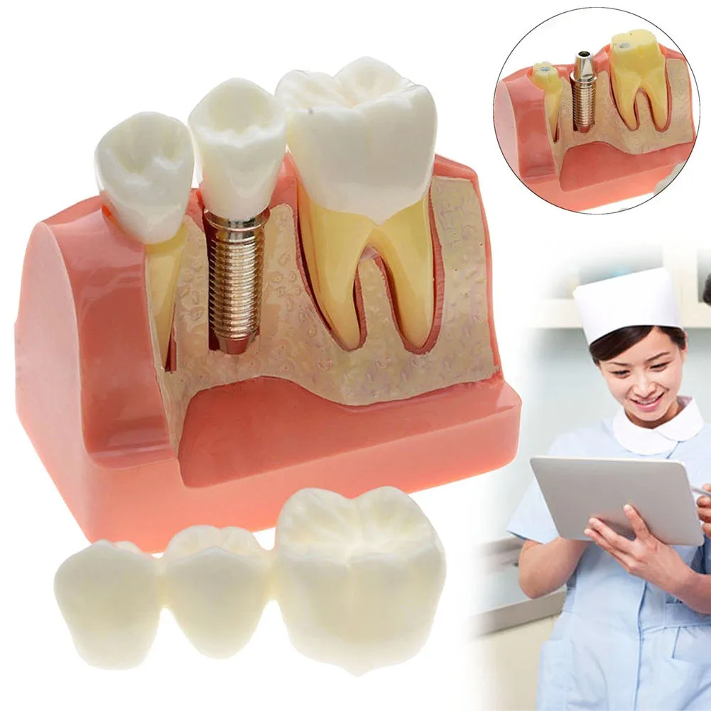 Dental Removable Teeth Implant Restoration Model Study Analysis Demonstration
Dental Removable Teeth Implant Restoration Model Study Analysis Demonstration