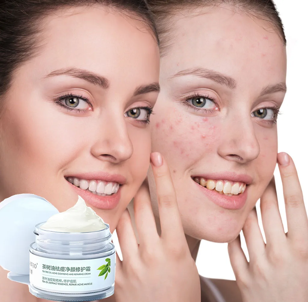 Effective anti-acne cream acne treatment fade acne spots oil control shrink pores whitening moisturizing acne cream skin care
Effective anti-acne cream acne treatment fade acne spots oil control shrink pores whitening moisturizing acne cream skin care