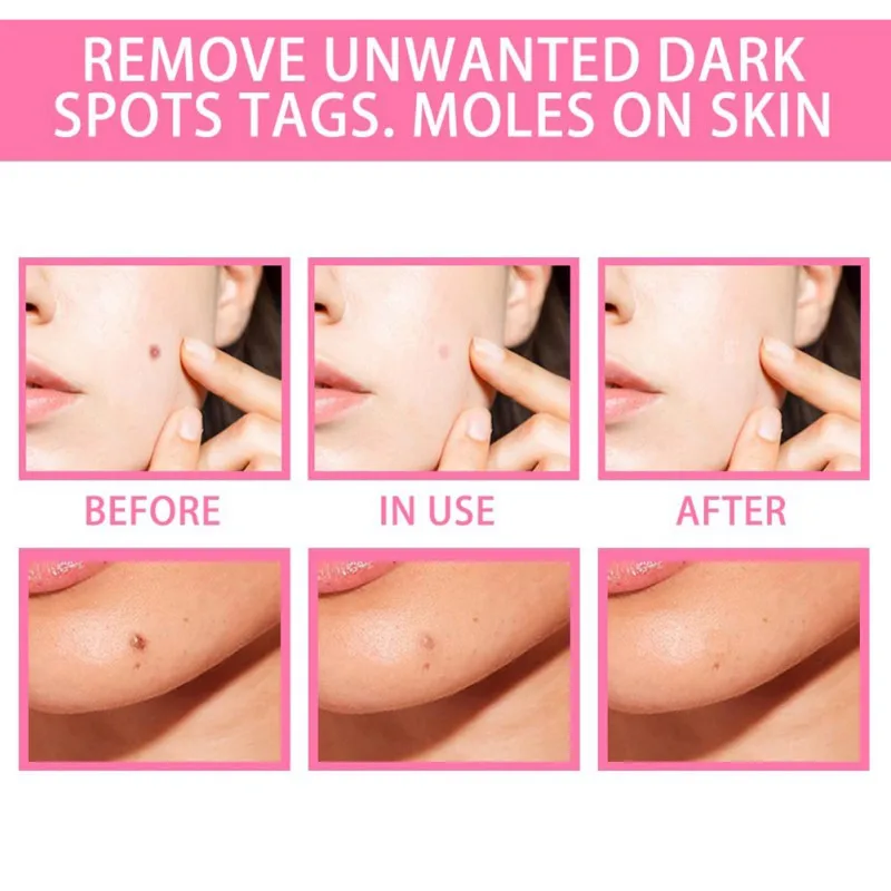 20ml Face Serum Instant Skin Tag Remover Wart Acne Spot Treatment Liquid Against Moles Fast Removal Anti Foot Corn Skin Care
20ml Face Serum Instant Skin Tag Remover Wart Acne Spot Treatment Liquid Against Moles Fast Removal Anti Foot Corn Skin Care