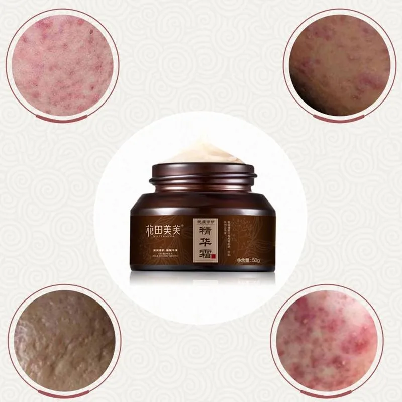 Scars Repairing Essence Cream Whitening Freckle Herbal Skin Face Remove Plant Spots Dark Care Repair Whitening Scar Cream 5 N9M5
Scars Repairing Essence Cream Whitening Freckle Herbal Skin Face Remove Plant Spots Dark Care Repair Whitening Scar Cream 5 N9M5