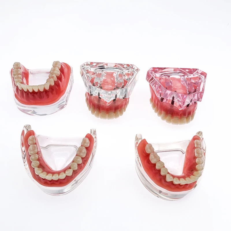 Стоматологическая модель зубов Съемный внутренний Mandibular демо Overdenture с имплантами верхний/нижний для обучения
Стоматологическая модель зубов Съемный внутренний Mandibular демо Overdenture с имплантами верхний/нижний для обучения