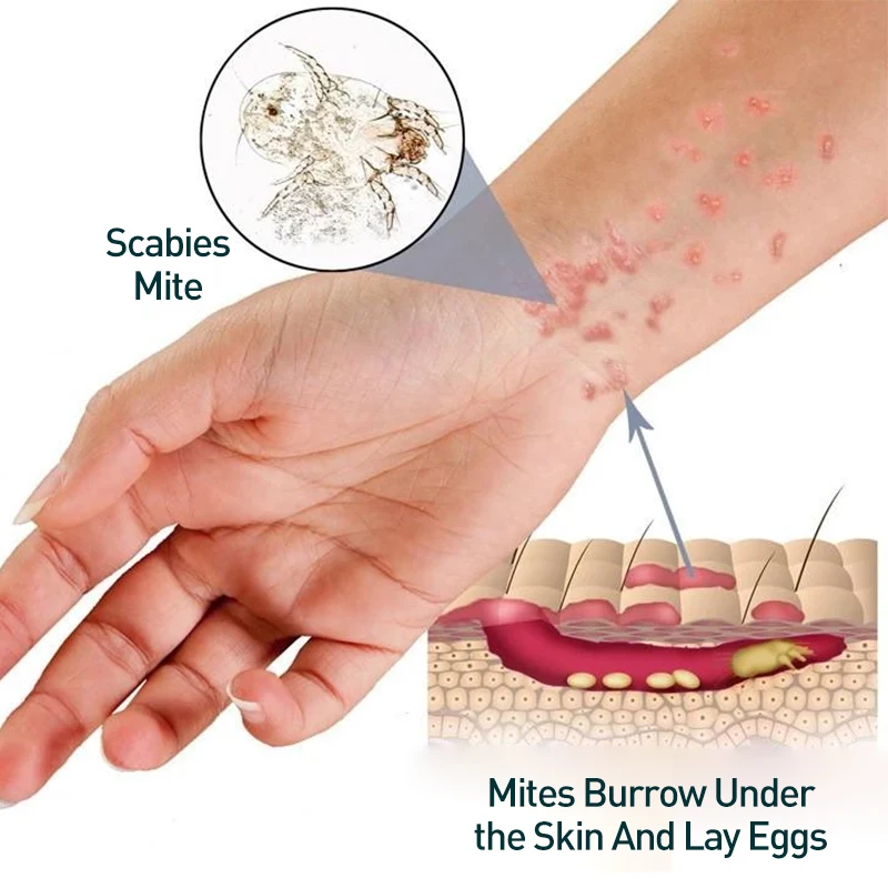 Lice anti-bacterial spray for children to remove lice eggs and anti-itch water spray anti-bacterial liquid for scabies mites
Lice anti-bacterial spray for children to remove lice eggs and anti-itch water spray anti-bacterial liquid for scabies mites