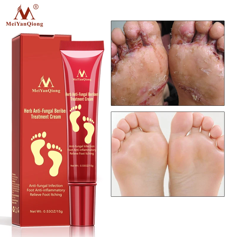 Herbal Foot Cream Anti Dry Crack Moisturizing Feet Care Anti Fungal Infection Onychomycosis Athletes Foot Antibacterial Cream
Herbal Foot Cream Anti Dry Crack Moisturizing Feet Care Anti Fungal Infection Onychomycosis Athletes Foot Antibacterial Cream