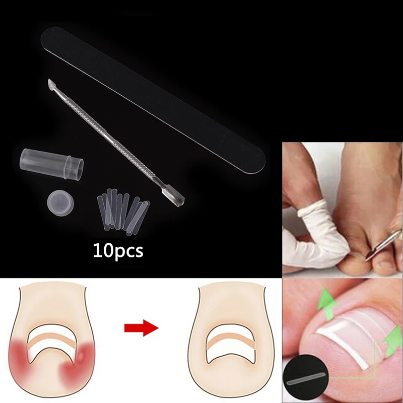 

1 комплект, набор для коррекции вросших ногтей, пилка для ногтей, выпрямляющая пластырь для ногтей, восстанавливающая Уход за ногами