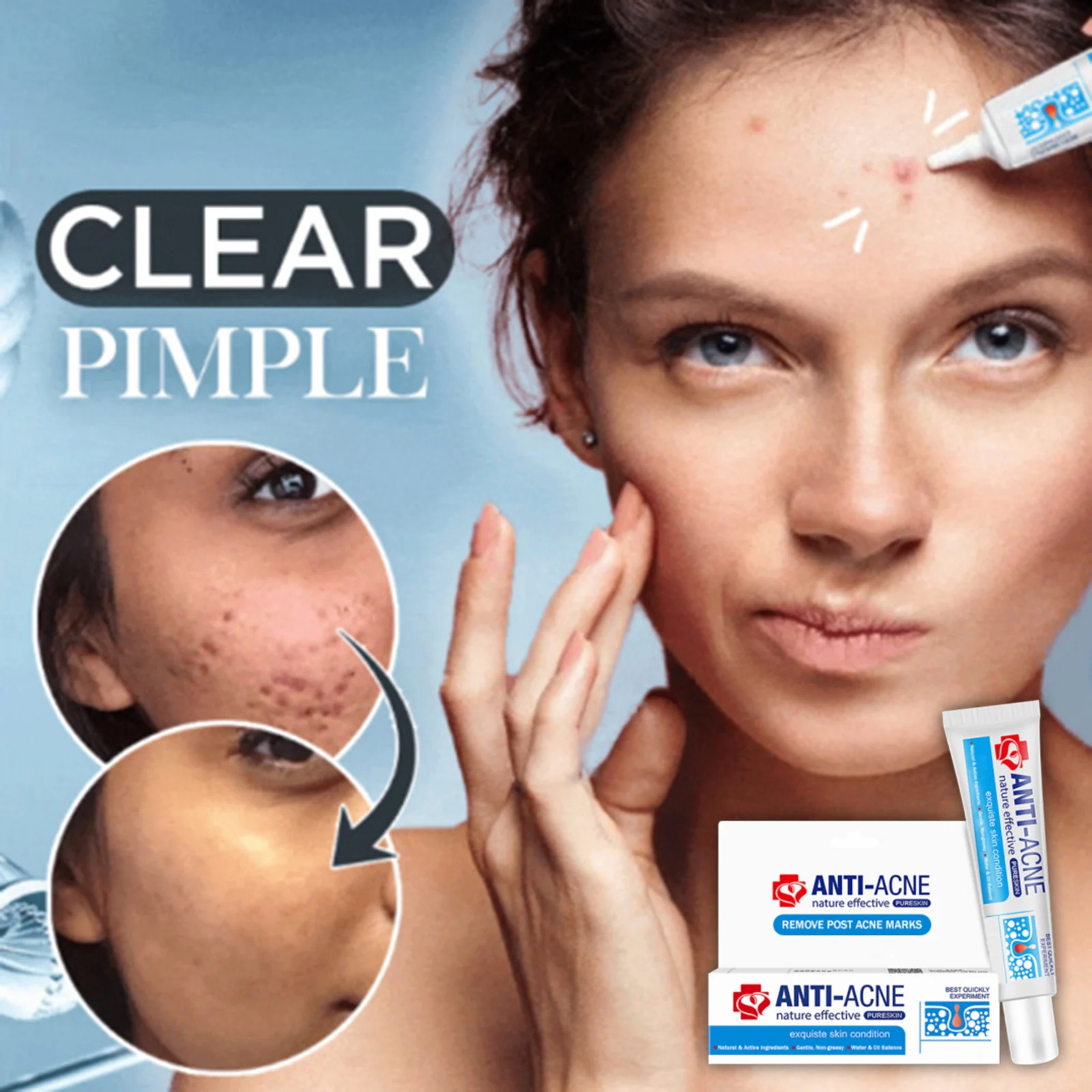 Blemish Removal Cream Anti-Acne Pimples Nature Herb Safe Acne Removal Cream J9
Blemish Removal Cream Anti-Acne Pimples Nature Herb Safe Acne Removal Cream J9