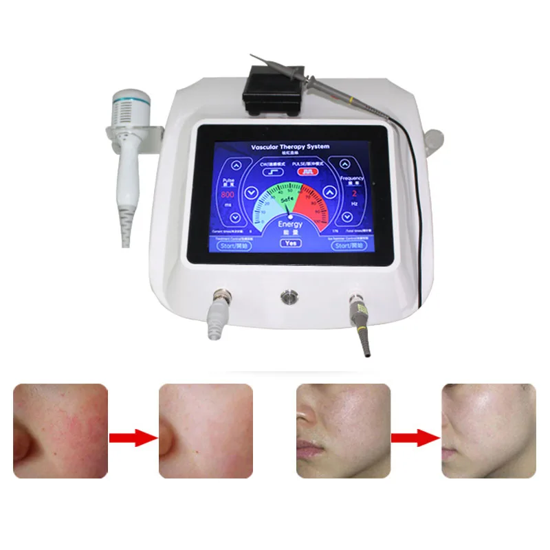980 high-frequency red blood streak removal instrument RF repair and improve redness beauty salon silk cleaning instrument
980 high-frequency red blood streak removal instrument RF repair and improve redness beauty salon silk cleaning instrument