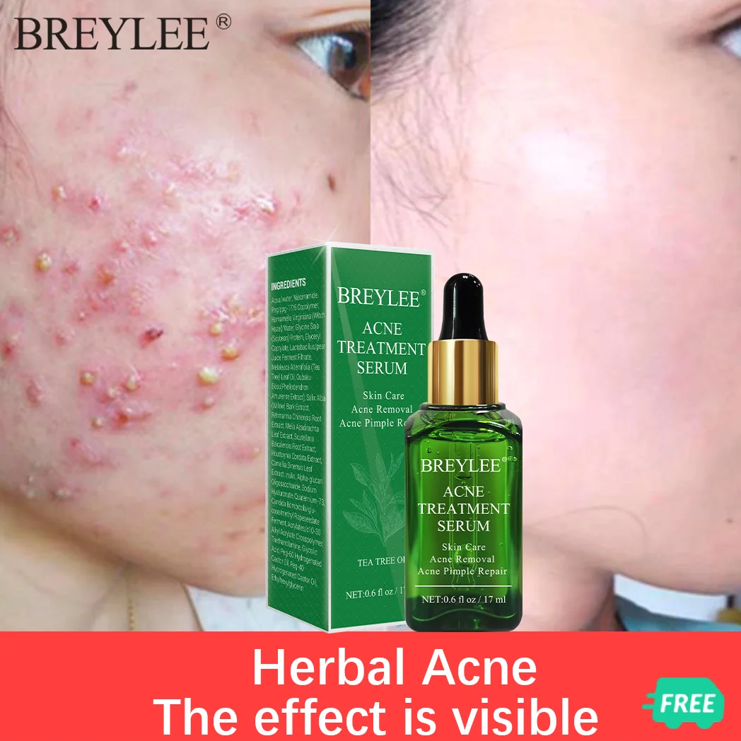 Breylee Acne Treatment Face Serum Mask Anti Acne Pimple Scar Remover Moisturizing Whitening Facial Essence Cream Skin Care 17ml
Breylee Acne Treatment Face Serum Mask Anti Acne Pimple Scar Remover Moisturizing Whitening Facial Essence Cream Skin Care 17ml