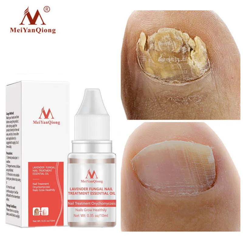 MeiYanQiong Fungal Nail Treatment Feet Care Essence Nail Fungas Foot Repair Toe Nail Fungus Removal Gel Paronychia Onychomycosis
MeiYanQiong Fungal Nail Treatment Feet Care Essence Nail Fungas Foot Repair Toe Nail Fungus Removal Gel Paronychia Onychomycosis