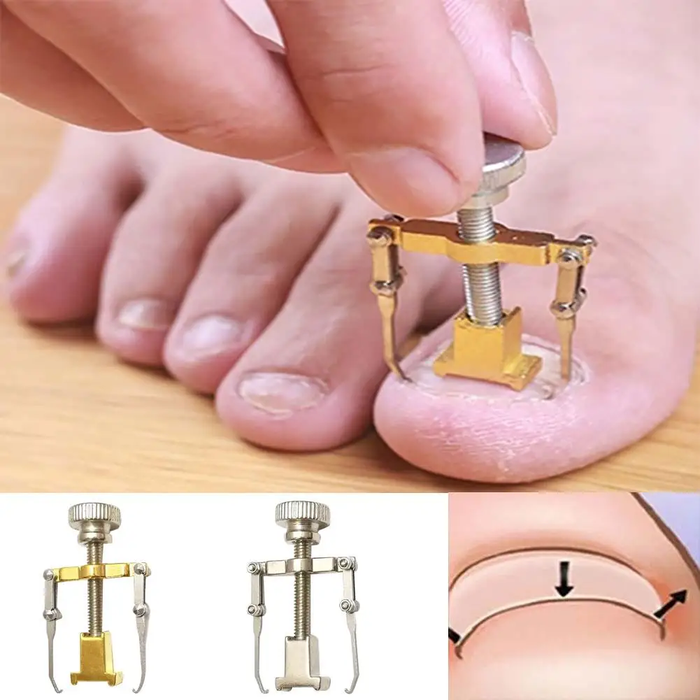 

Ingrown Toenail Toe Fixer Recover Correction Device Pedicure Foot Nail Care Tool Straightening Clip Brace corrector Wire Fixer