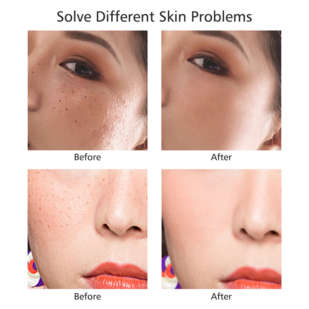 Mini Laser Plasma Pen Portable Laser Tattoo Freckle Remover Mole Removal Machine Dark Spot Eraser Face Care Skin Tag RemoverTool
Mini Laser Plasma Pen Portable Laser Tattoo Freckle Remover Mole Removal Machine Dark Spot Eraser Face Care Skin Tag RemoverTool
