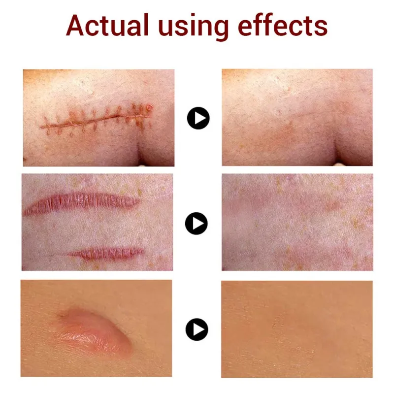 Natural Herb Repair Acne Treatment Cream Professional Scar Treatment Whitening Face Cream Stretch Mark Skin Care Cream
Natural Herb Repair Acne Treatment Cream Professional Scar Treatment Whitening Face Cream Stretch Mark Skin Care Cream