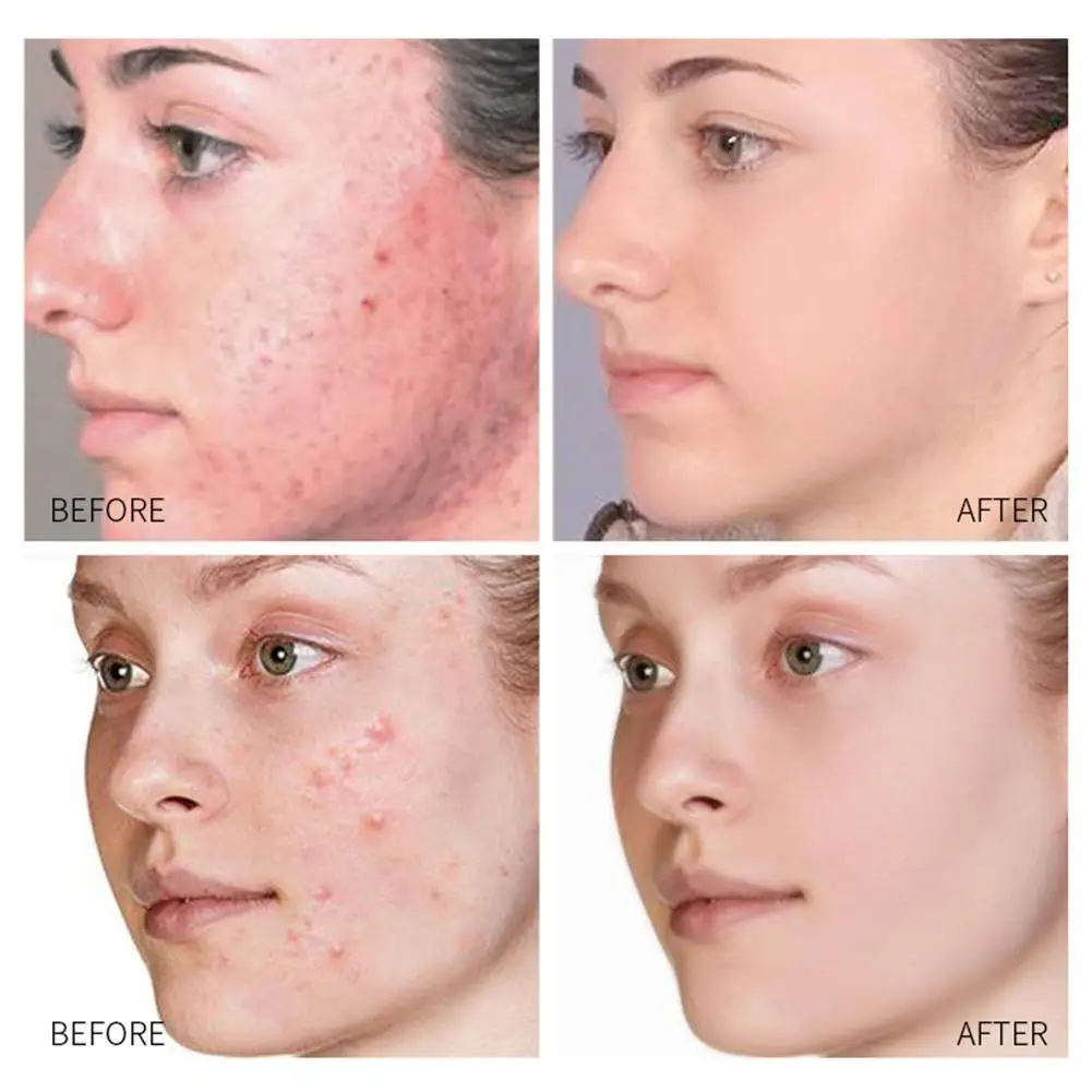 New Style Effective Acne Scar Removal Cream Fade Acne Remover Shrink Spots Acne Pores Oil Cream Control G1J7
New Style Effective Acne Scar Removal Cream Fade Acne Remover Shrink Spots Acne Pores Oil Cream Control G1J7