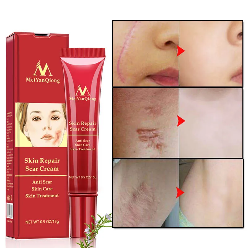 15g Scar Removal Cream Acne Scars Gel Stretch Marks Surgical Scar Burn For Body Pigmentation Corrector Acne Spots Repair Care
15g Scar Removal Cream Acne Scars Gel Stretch Marks Surgical Scar Burn For Body Pigmentation Corrector Acne Spots Repair Care