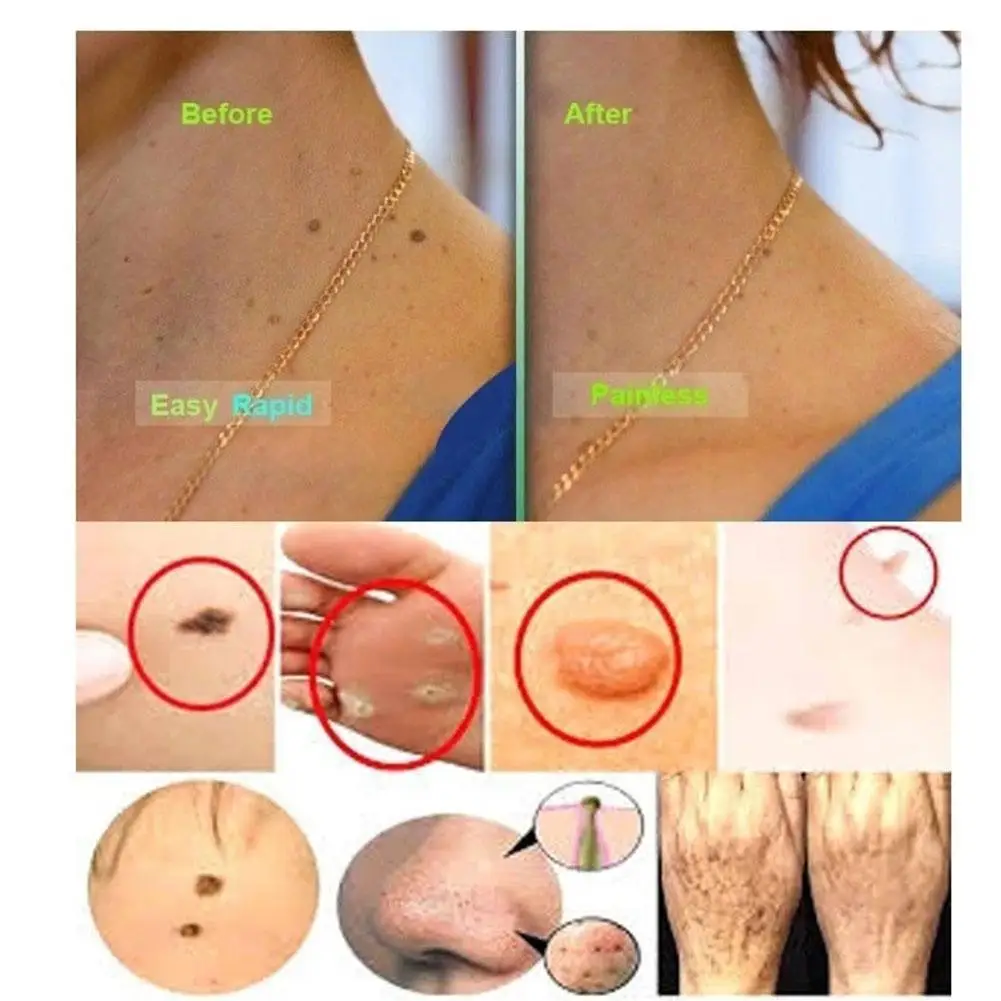 10Ml Skin Tag Remover Genital Warts Treatment Instant Papillomas & Repair Natural Tool Mole Liqu Bacteriostatic Remove Corn R7S3
10Ml Skin Tag Remover Genital Warts Treatment Instant Papillomas & Repair Natural Tool Mole Liqu Bacteriostatic Remove Corn R7S3