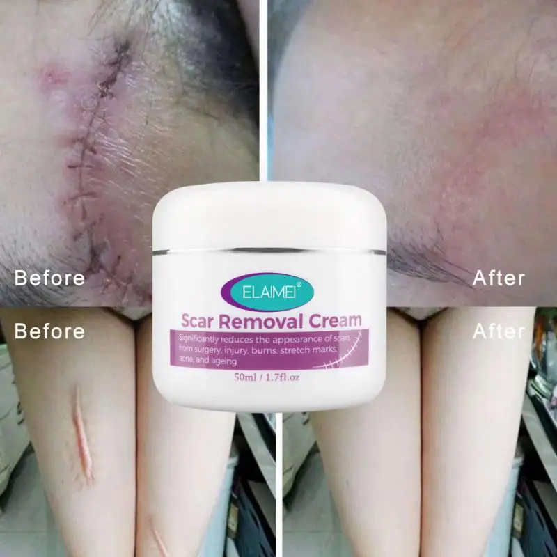 50g Stretch Marks Remover Pregnancy Scars Ance Cream Maternity Repair Anti Aging Winkles Firming Care Dropshipping
50g Stretch Marks Remover Pregnancy Scars Ance Cream Maternity Repair Anti Aging Winkles Firming Care Dropshipping