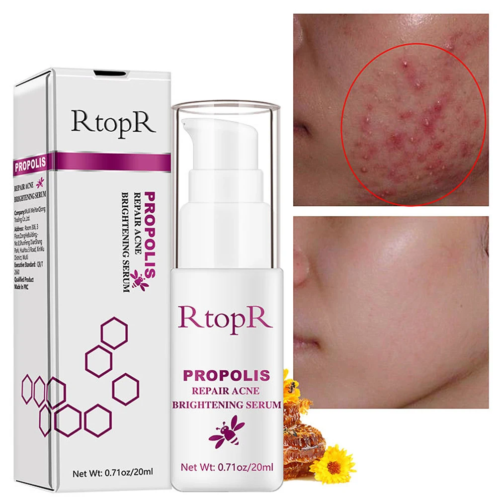 Acne Treatment Pore Cleaning Face Serum Anti Acne Repairing Essence Oil Control Skin Care Brightening Skin Tone
Acne Treatment Pore Cleaning Face Serum Anti Acne Repairing Essence Oil Control Skin Care Brightening Skin Tone
