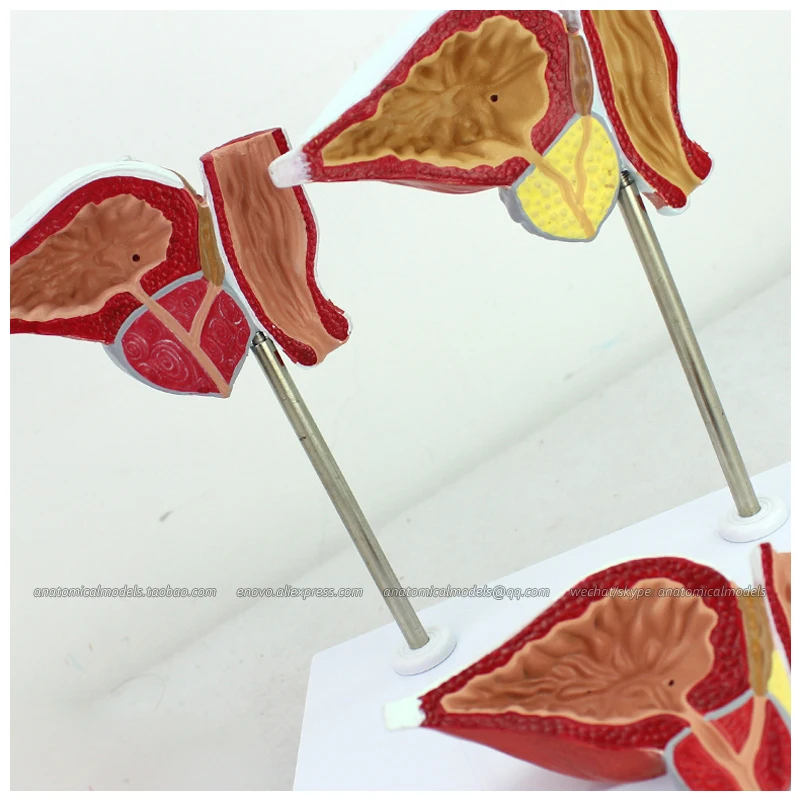 12427 / Normal and Diseased Prostate Gland Anatomy Model, Medical Science Educational Teaching Anatomical Models
12427 / Normal and Diseased Prostate Gland Anatomy Model, Medical Science Educational Teaching Anatomical Models