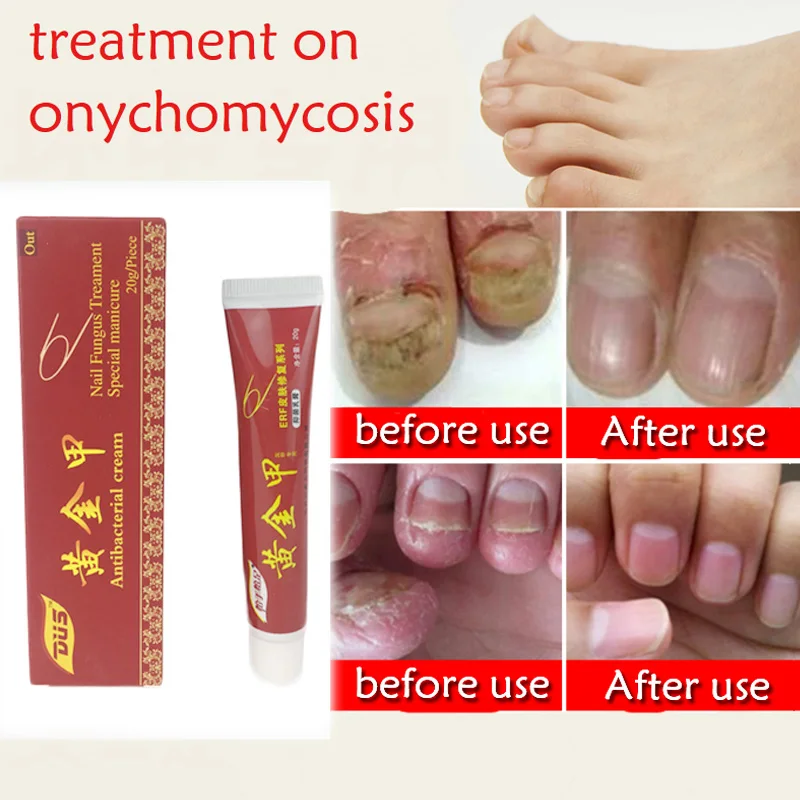 Chinese Medicine Plaster Nail Fungus Treatment Cream Onychomycosis Anti Fungal Nail Infection Fights Bacteria Naturally Ointment 
Chinese Medicine Plaster Nail Fungus Treatment Cream Onychomycosis Anti Fungal Nail Infection Fights Bacteria Naturally Ointment
