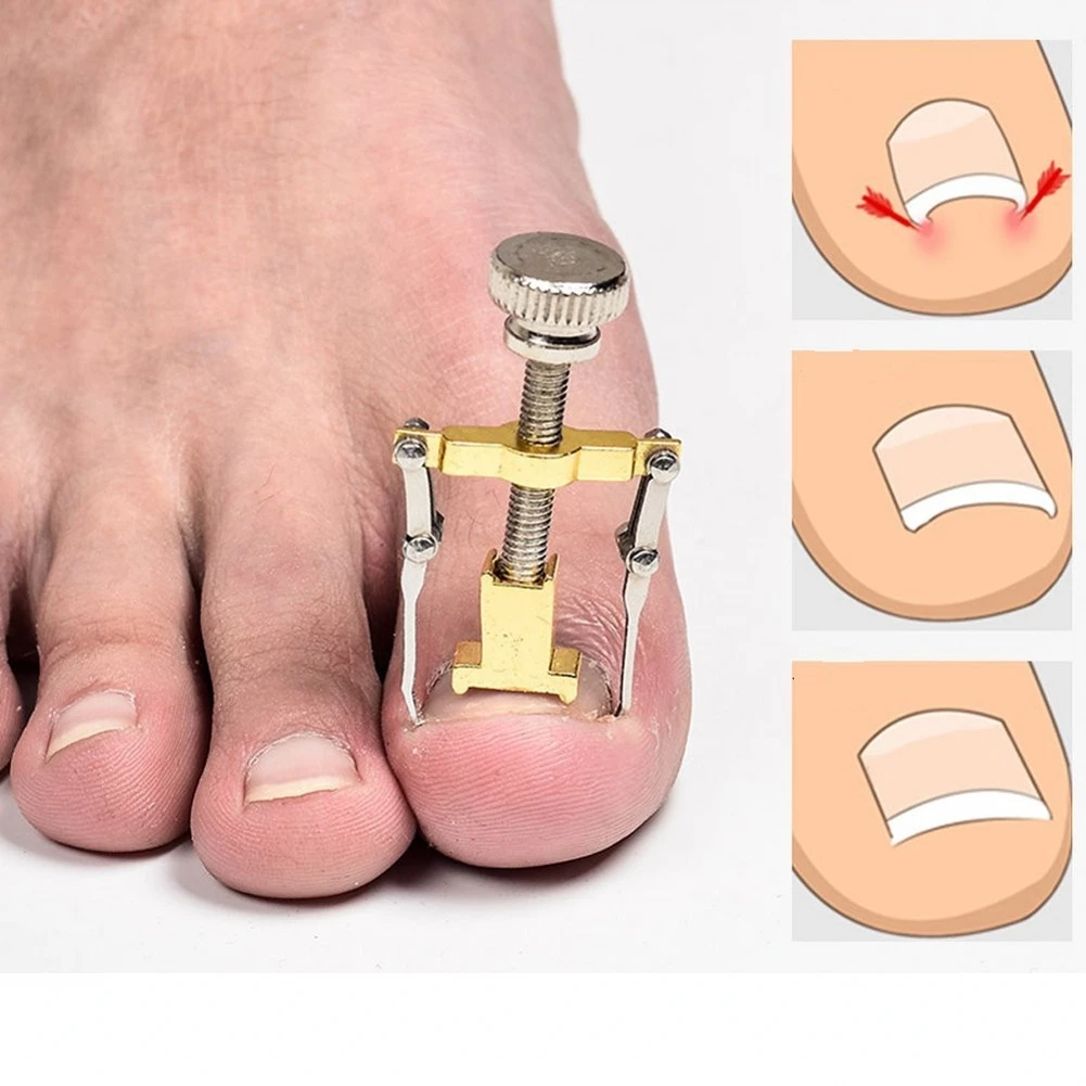 1 pc nail tools toenail curl correction pliers ingrown nail correction device nail picking device nail correction device
1 pc nail tools toenail curl correction pliers ingrown nail correction device nail picking device nail correction device