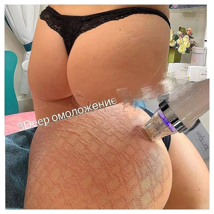 2 Handles RF Face Lift Fractional Micro Needle Stretch Marks Removal Scar Acne Spots Freckle Treatment RF Equipment Cold Hammer
2 Handles RF Face Lift Fractional Micro Needle Stretch Marks Removal Scar Acne Spots Freckle Treatment RF Equipment Cold Hammer