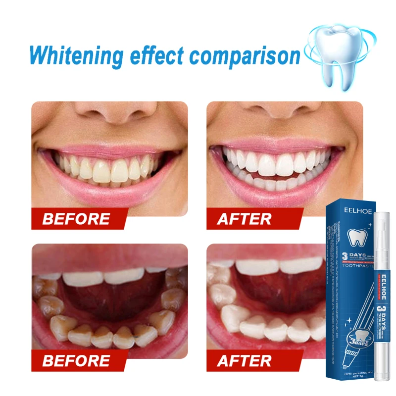 Teeth Whitening Pen Cleaning Serum Plaque Stains Remover Teeth Bleachment Whitener Oral Hygiene Teeth Care New TSLM1
Teeth Whitening Pen Cleaning Serum Plaque Stains Remover Teeth Bleachment Whitener Oral Hygiene Teeth Care New TSLM1