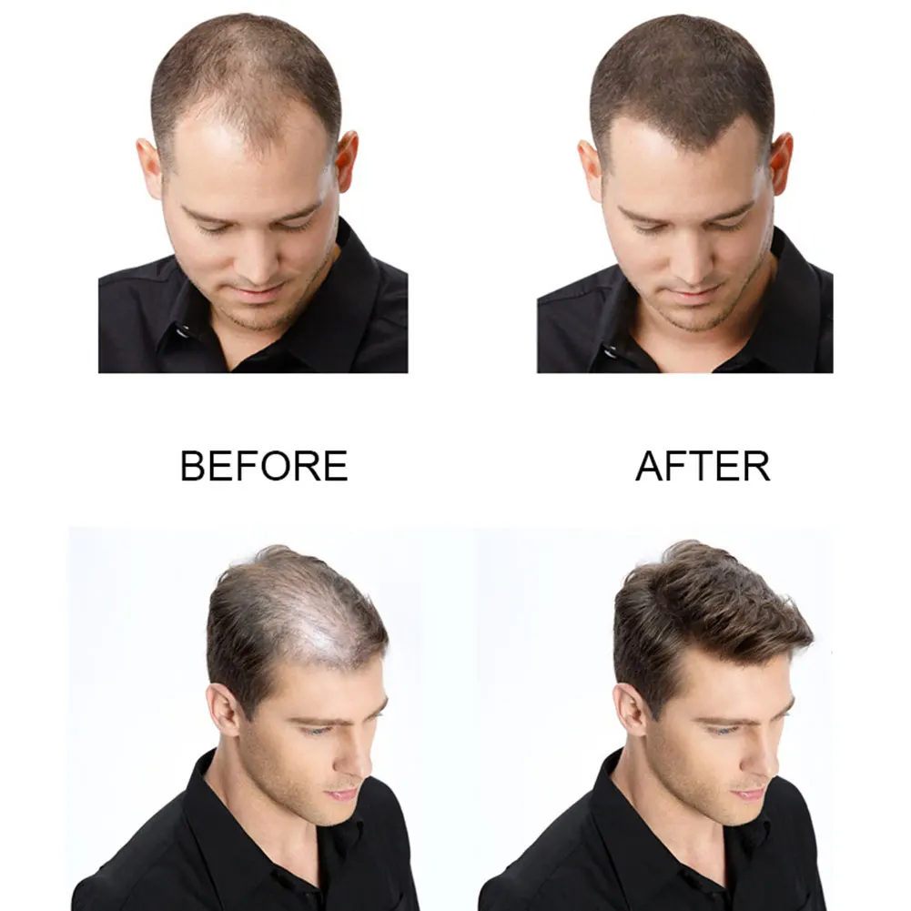 Accelerate hair growth Hair Hair LossTreatment Preventing Hair Loss Hair Care, 30ml
Accelerate hair growth Hair Hair LossTreatment Preventing Hair Loss Hair Care, 30ml
