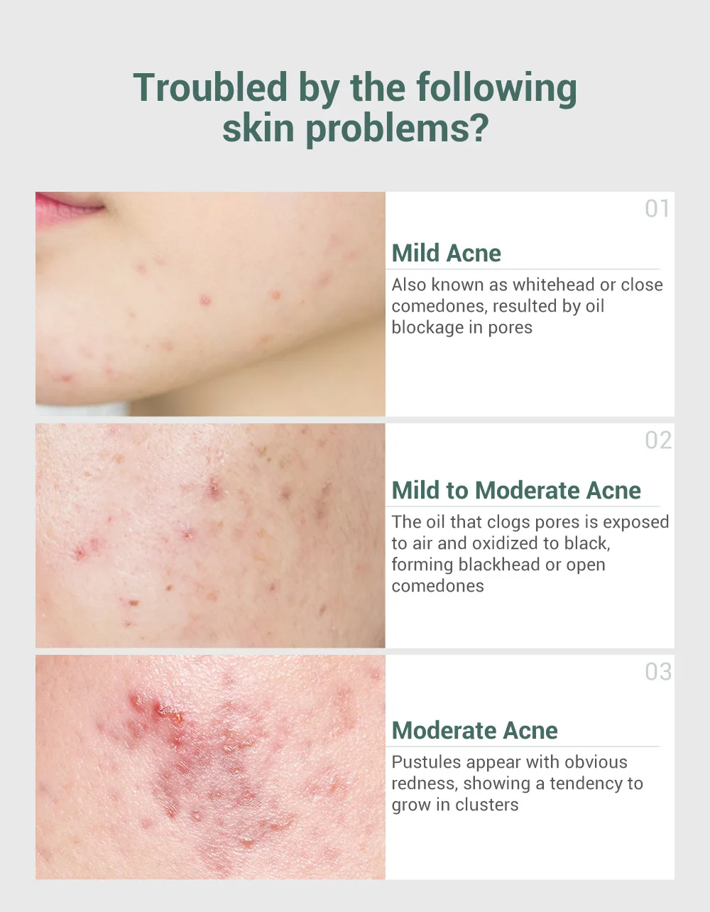 LANBENA EGF Remover Scar Cream Stretch Mark Gel Anti Acne Cream Acne Treatment Blackhead Whitening Skin Care Repair Face Cream
LANBENA EGF Remover Scar Cream Stretch Mark Gel Anti Acne Cream Acne Treatment Blackhead Whitening Skin Care Repair Face Cream