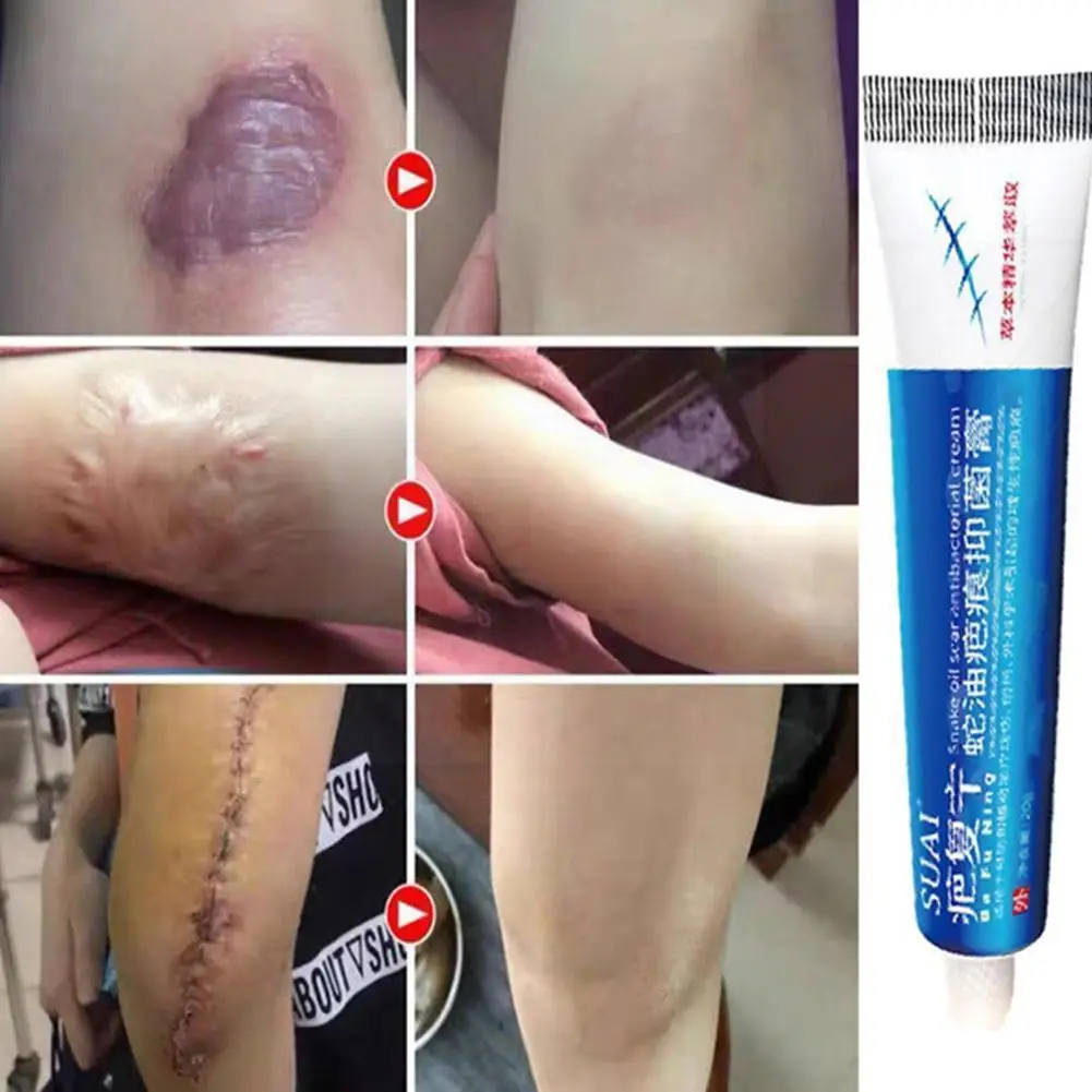Acne Scar Removal Cream Pimples Stretch Marks Face Moisturizing Acne Remove Body Whitening Smoothing Gel Care Skin Z6h2
Acne Scar Removal Cream Pimples Stretch Marks Face Moisturizing Acne Remove Body Whitening Smoothing Gel Care Skin Z6h2