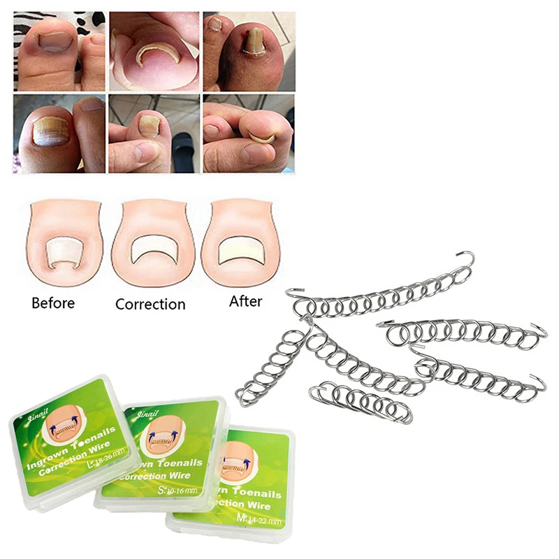 Pedicure Acronyx Wire Nail Ingrown Correction Wire Patch Foot Care Paronychia Correction File Spring Ingrown Toe Tools
Pedicure Acronyx Wire Nail Ingrown Correction Wire Patch Foot Care Paronychia Correction File Spring Ingrown Toe Tools