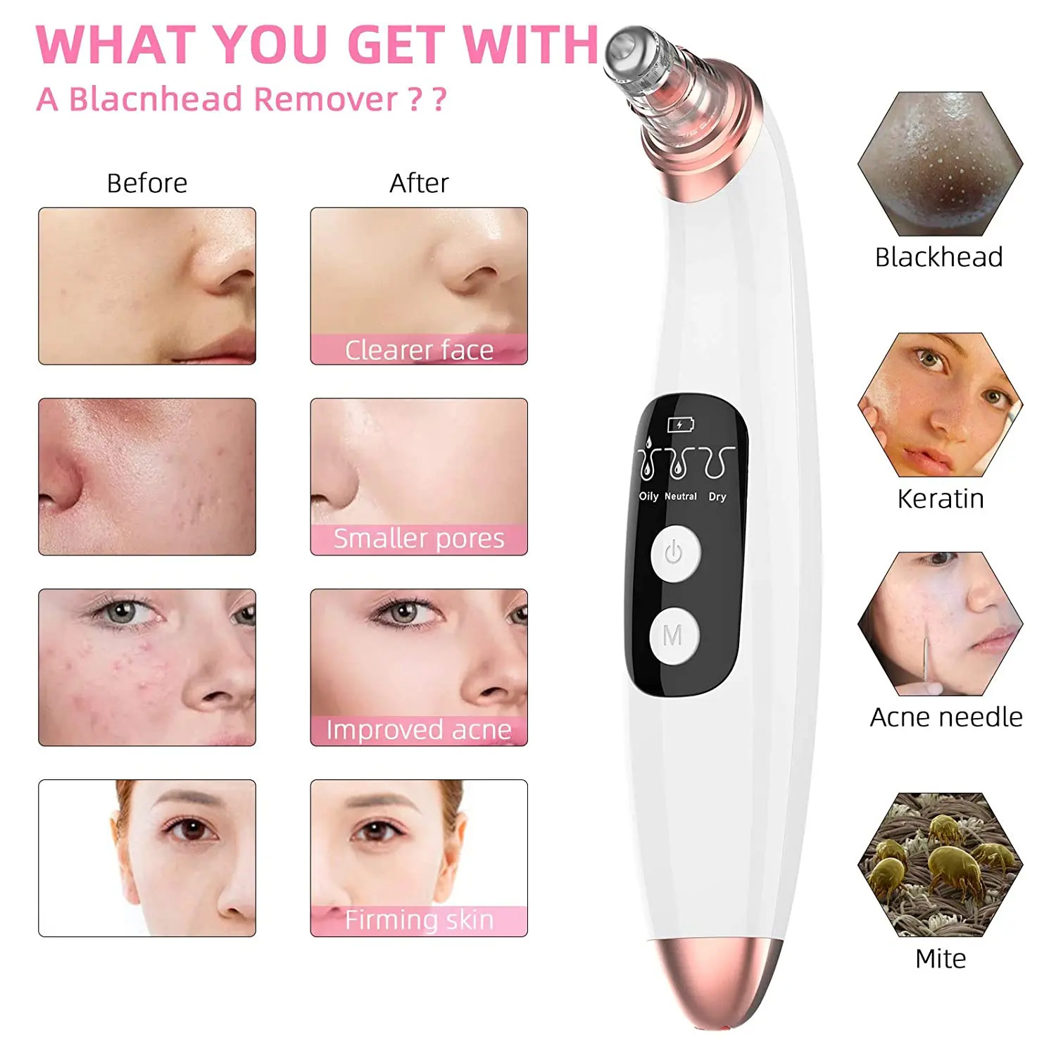 Электрический пылесос для удаления черных точек, вакуумный очиститель пор, ультразвуковой скруббер для кожи, экстрактор акне, нано-спрей дл...
Электрический пылесос для удаления черных точек, вакуумный очиститель пор, ультразвуковой скруббер для кожи, экстрактор акне, нано-спрей дл...