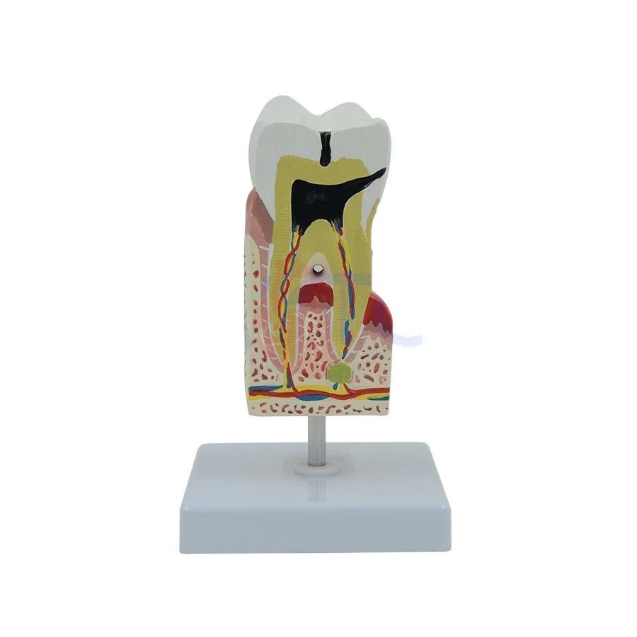 Enlarged Human Teeth Care Model Tooth Decay Dental Caries Medical Student Medical Supplies Teaching Resources Anatomical Model
Enlarged Human Teeth Care Model Tooth Decay Dental Caries Medical Student Medical Supplies Teaching Resources Anatomical Model