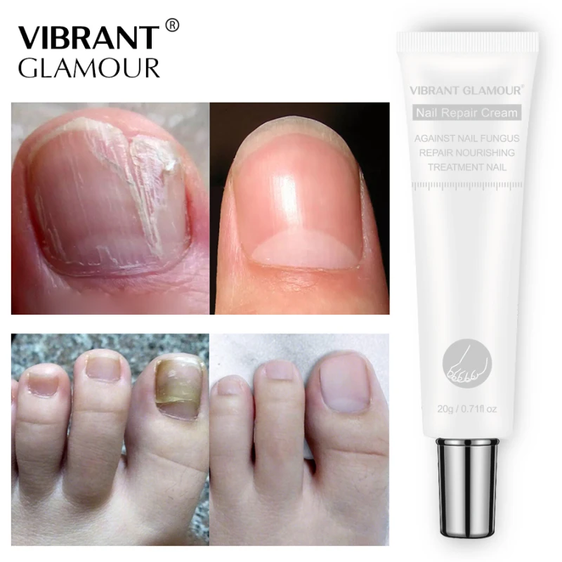 Яркие Гламурные 20g гвоздь ToeRepair крем Лечение грибка ногтей онихомикоз удаления