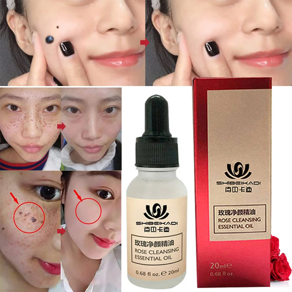 Skin Tag Remover Against Mole & Genital Wart fast RemovWithin al Anti Foot Corn Removal Warts Papillomas Rapidly removes moles
Skin Tag Remover Against Mole & Genital Wart fast RemovWithin al Anti Foot Corn Removal Warts Papillomas Rapidly removes moles