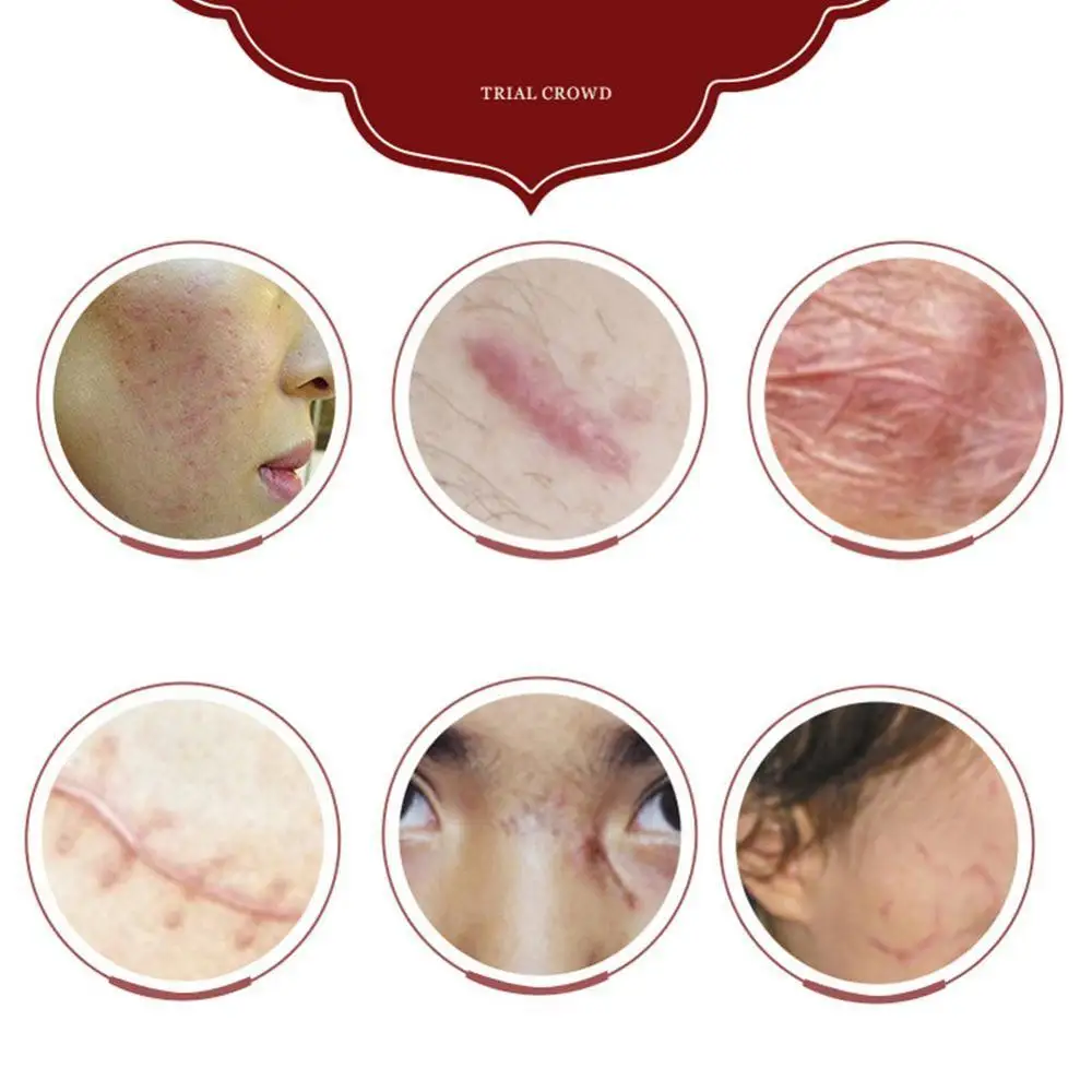 Powerful whitening freckle cream Chinese herbal plant spots Skin dark and remove cream whitening cream freckles face 30g B0J0
Powerful whitening freckle cream Chinese herbal plant spots Skin dark and remove cream whitening cream freckles face 30g B0J0