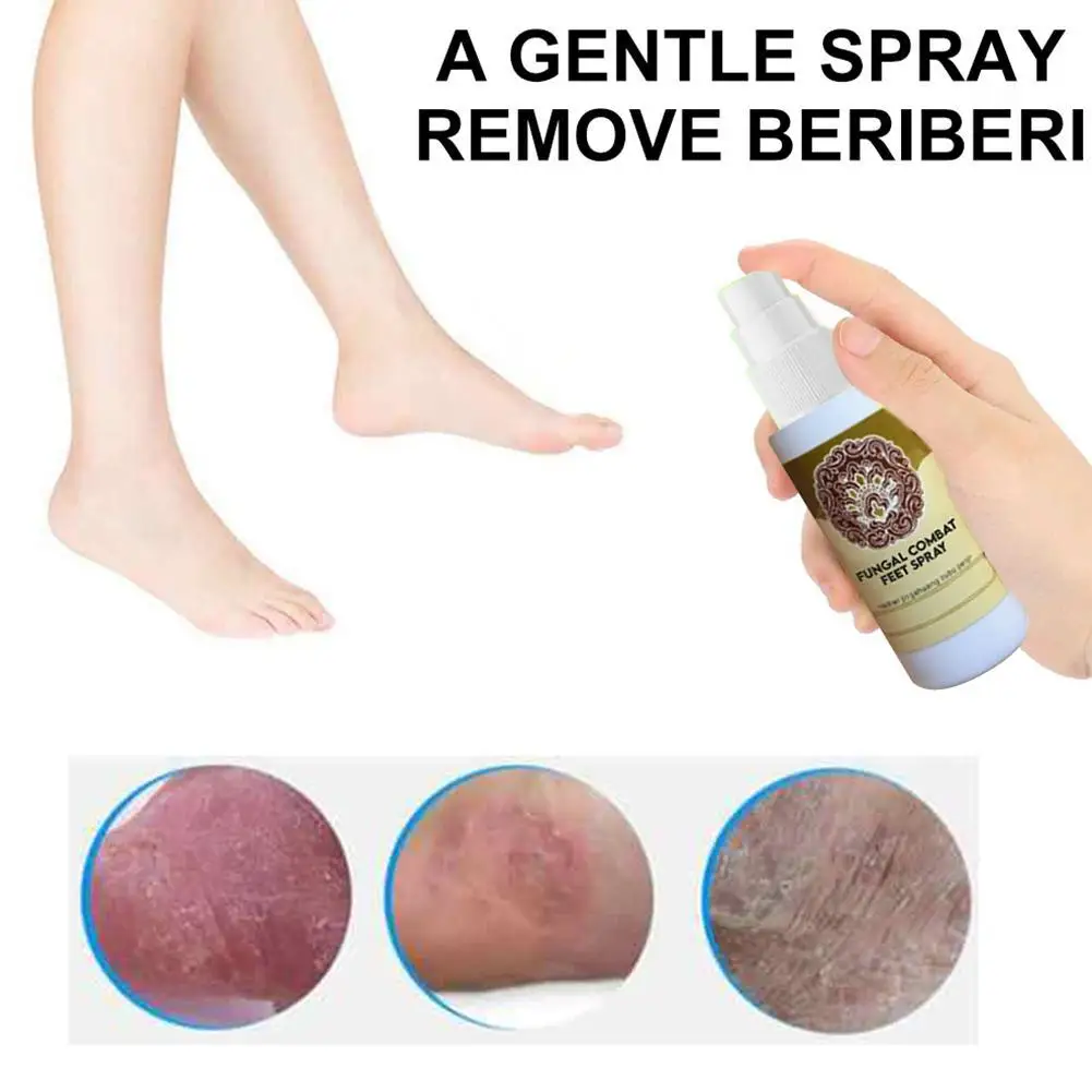 Fungal Combat Anti Feet Fungal Infections Athlete's Foot Sprayer For Beriberi Itch Erosion Peeling Anti Bacterial Blisters
Fungal Combat Anti Feet Fungal Infections Athlete's Foot Sprayer For Beriberi Itch Erosion Peeling Anti Bacterial Blisters