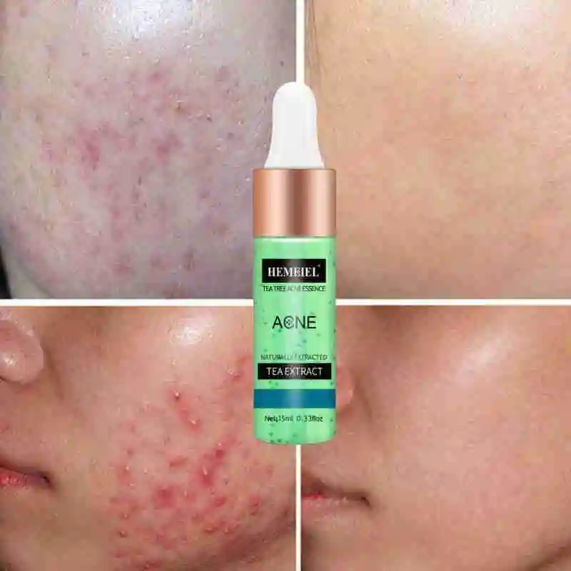 15ml Whitening and moisturizing essence acne can effectively reduce acne spots Shrink Pore Whitening Moisturizing Essence Face C
15ml Whitening and moisturizing essence acne can effectively reduce acne spots Shrink Pore Whitening Moisturizing Essence Face C