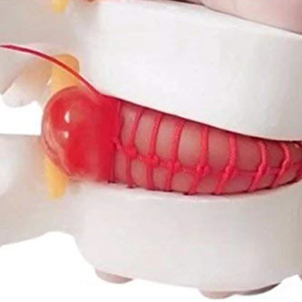 1pc Anatomical Lumbar Disc Herniation Lumbar Spine Model White Color THIN889
1pc Anatomical Lumbar Disc Herniation Lumbar Spine Model White Color THIN889