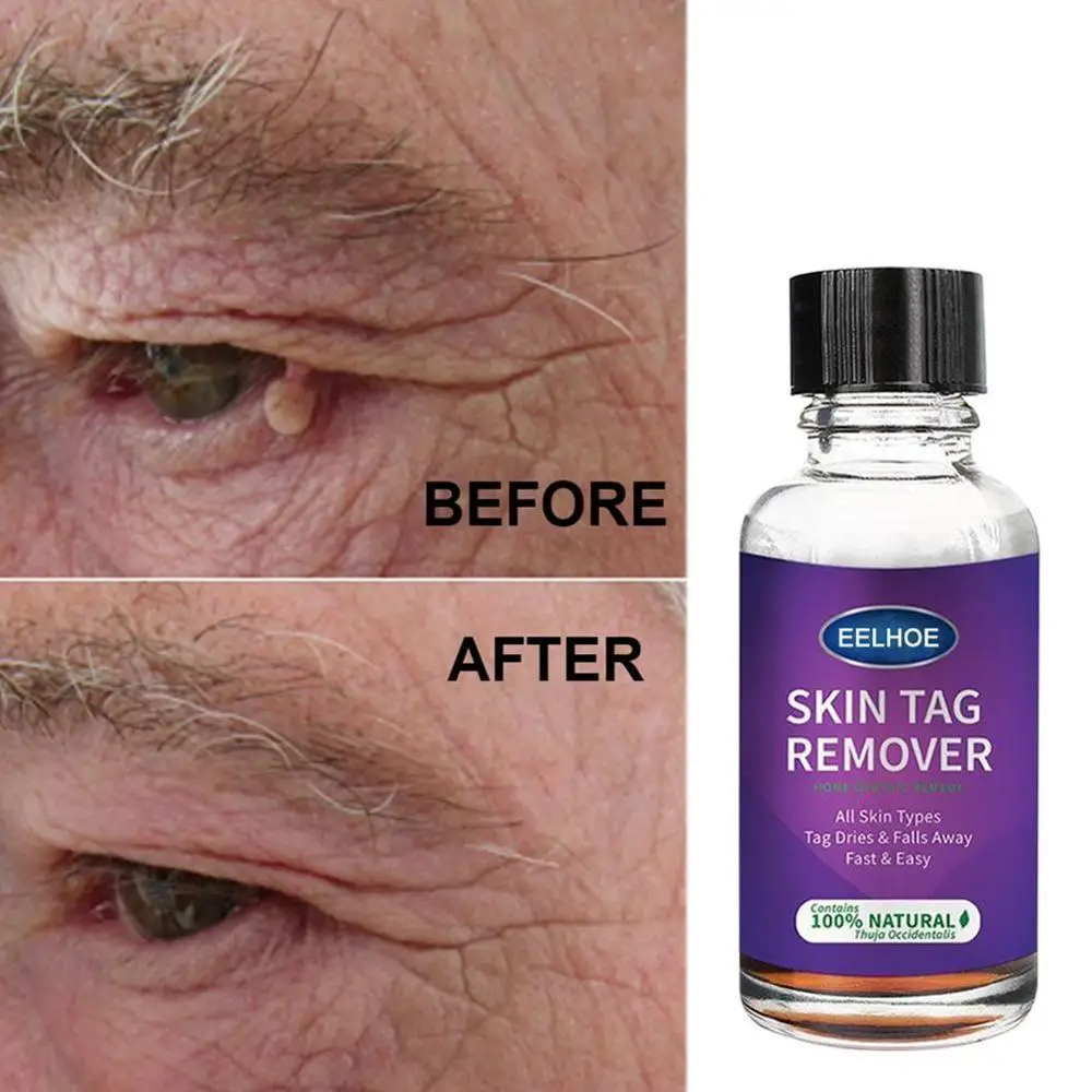 Genital Warts Removal Antibacterial Liquid Foot Calluses Corn Cream Flat Medical Relief Wart Care Meat Skin Treatment Skin R1S0
Genital Warts Removal Antibacterial Liquid Foot Calluses Corn Cream Flat Medical Relief Wart Care Meat Skin Treatment Skin R1S0